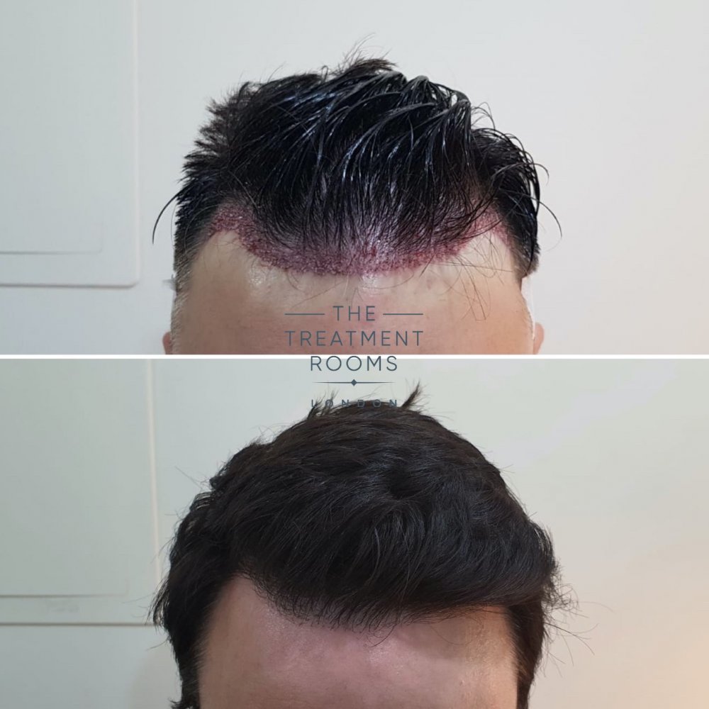 Hair Transplant Hairline Before and After Straight hair.jpg