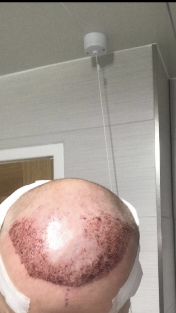 Hair transplant hairline.png