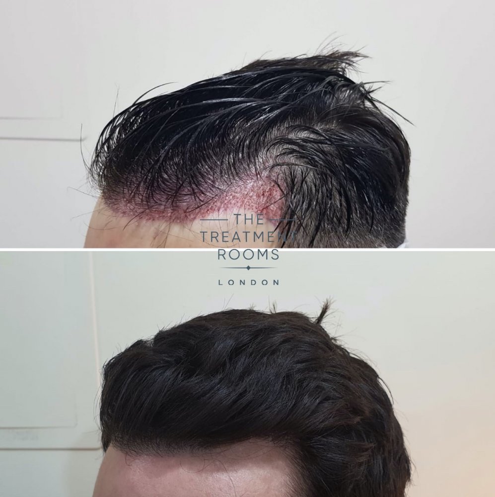 Hair Transplant London Before and After Straight hair.jpg
