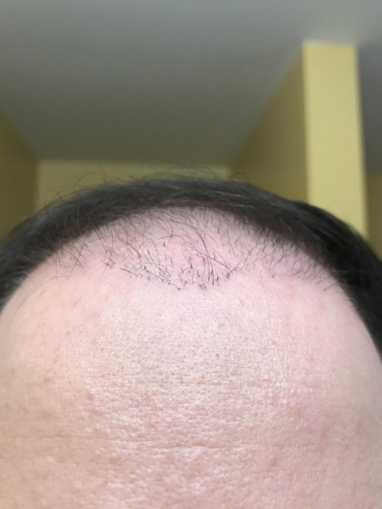 Hair Transplant Plugs.jpeg