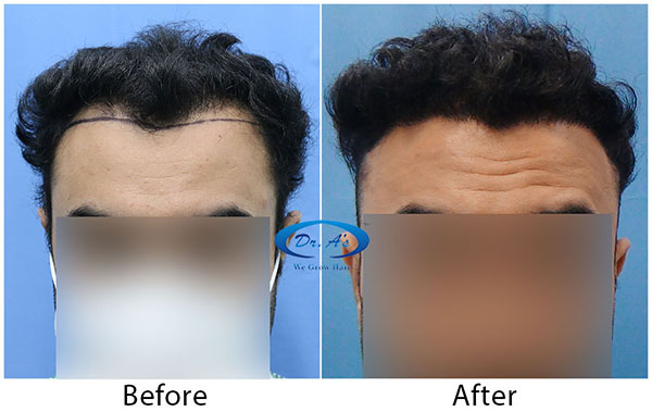 Hair-Transplant-Result(1)-DrAsClinic .JPG