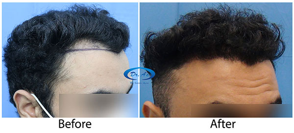 Hair-Transplant-Result(2)-DrAsClinic.jpg