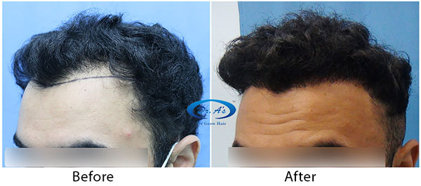 Hair-Transplant-Result(3)-DrAsClinic.jpg