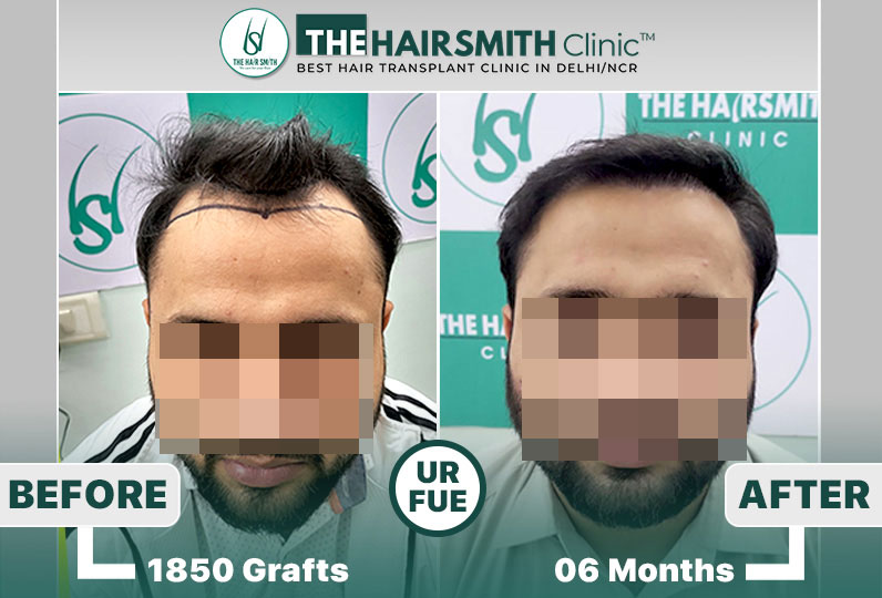 hair transplant result.jpg