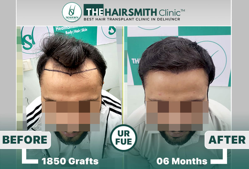 hair transplant results delhi.jpg