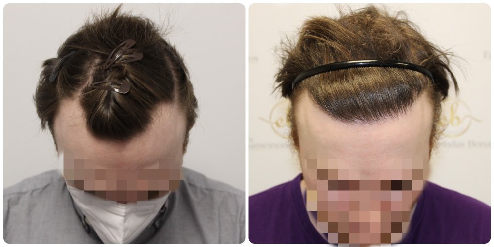 hair-transplant-results-uk-dr-bonaros.jpg
