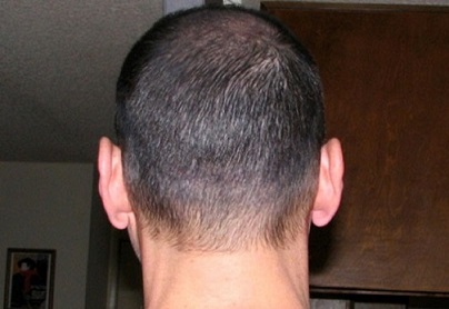 Hair transplant scar with couvre.jpg
