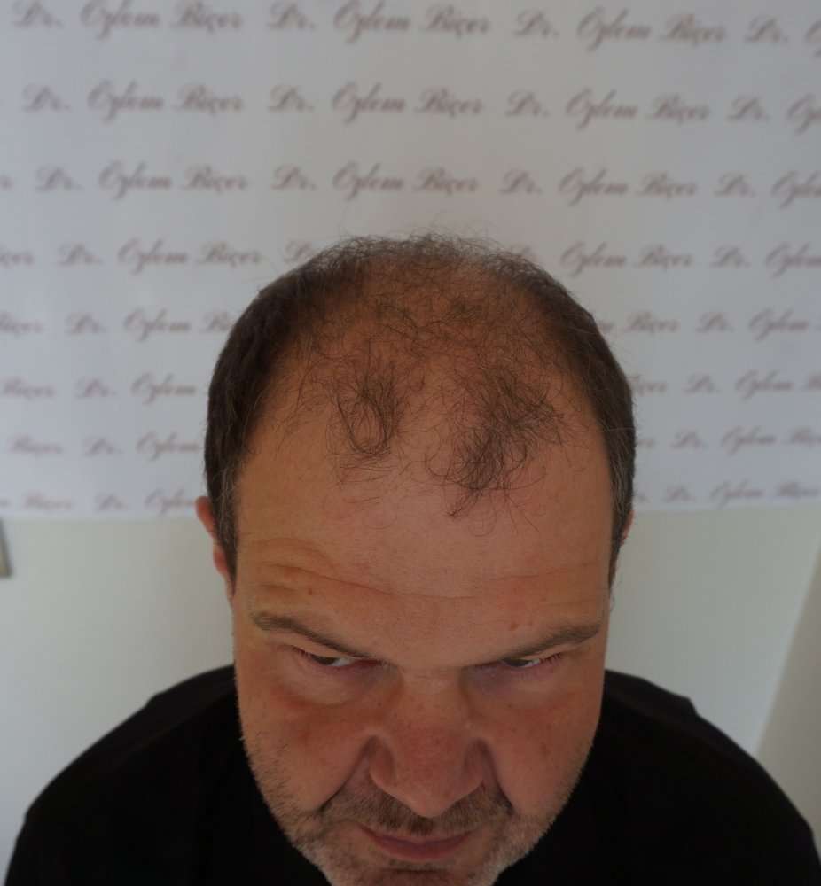 Hair transplant with Dr Bicer in Turkey.jpeg