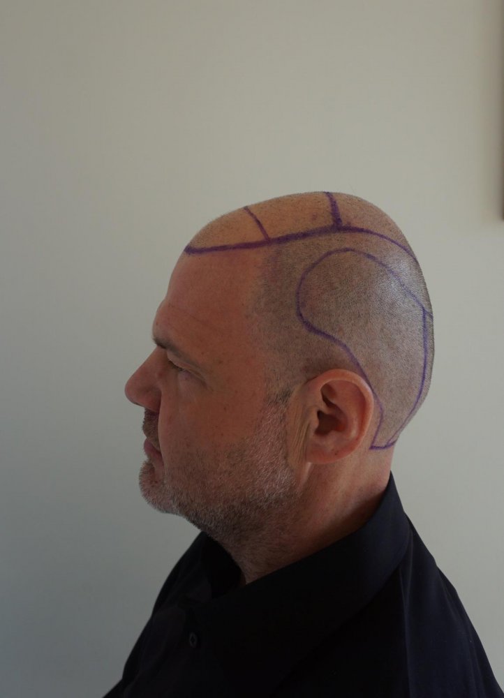 Hair transplant with Dr Bicer in Turkey1.jpeg