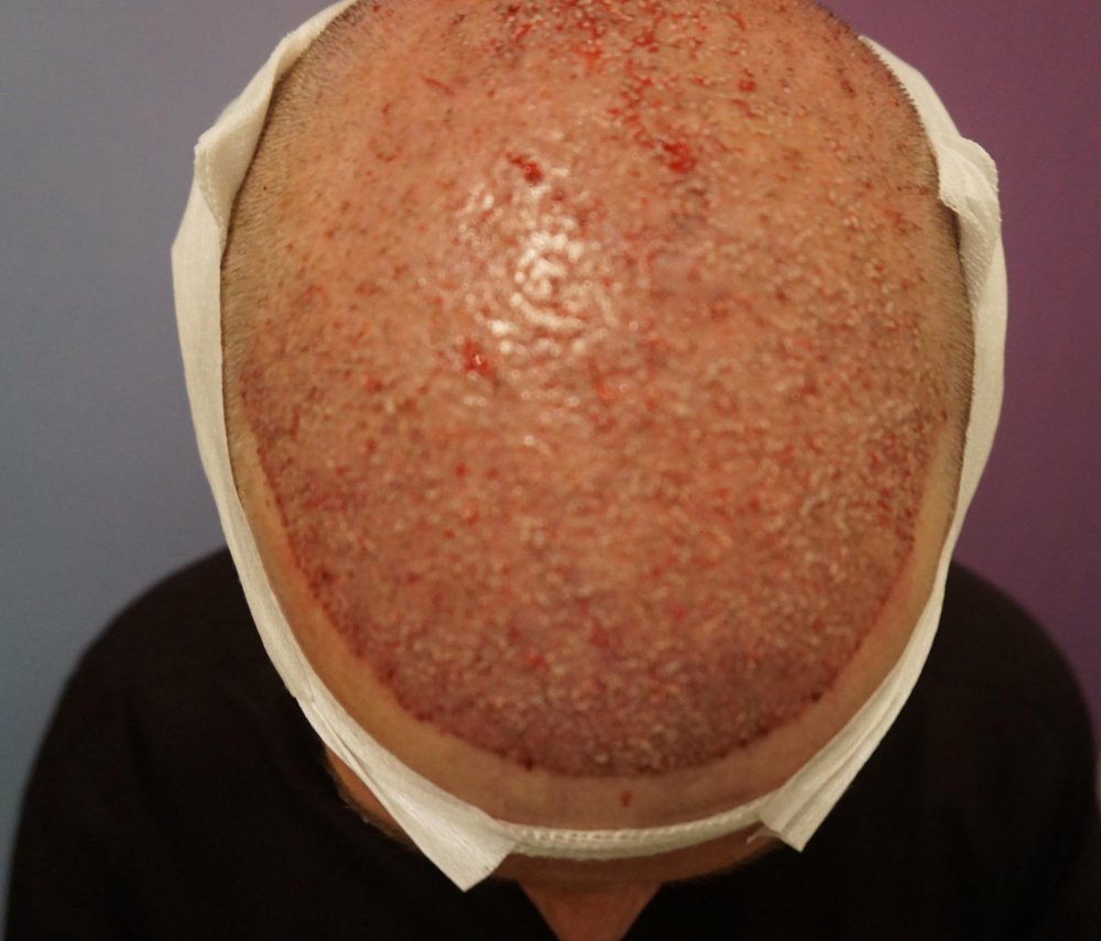 Hair transplant with Dr Bicer in Turkey2.jpeg
