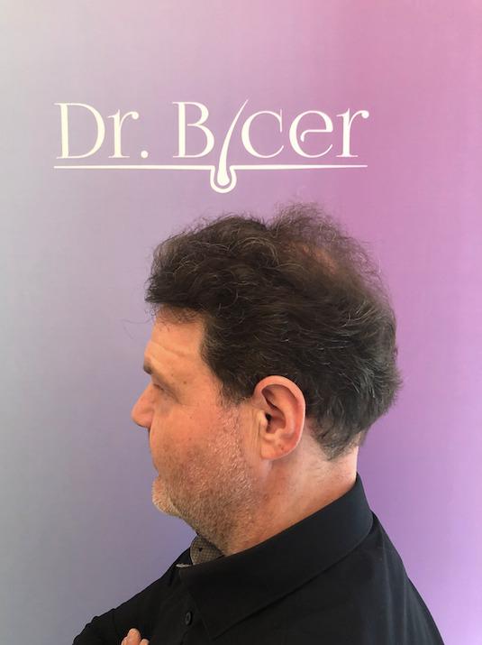 Hair transplant with Dr Bicer in Turkey4.jpeg