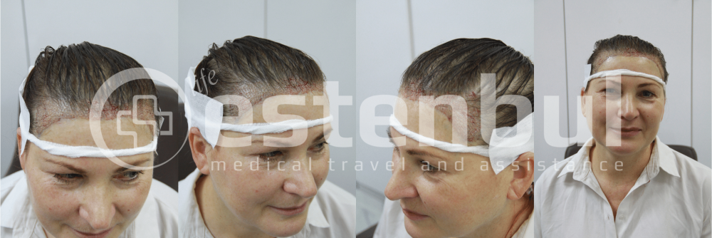hair transplant with estenbul health.png