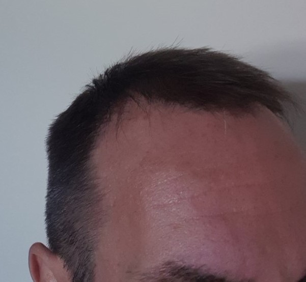 hair transplant with fine hair..jpg