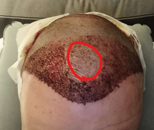 hair transplant_LI.jpg