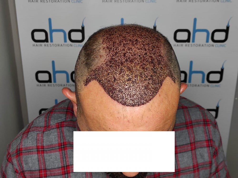 hair trasplant.jpeg