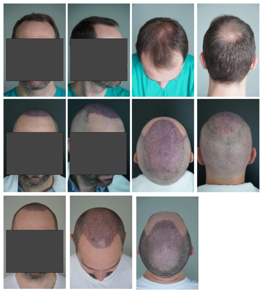 Hair_transplant_before_after.jpg