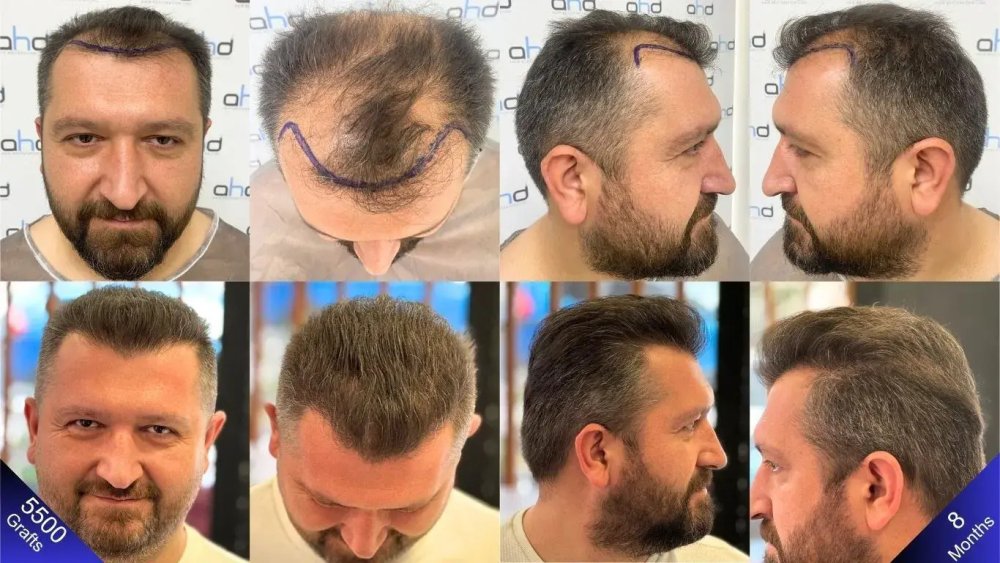 hair_transplant_result_turkey.jpg