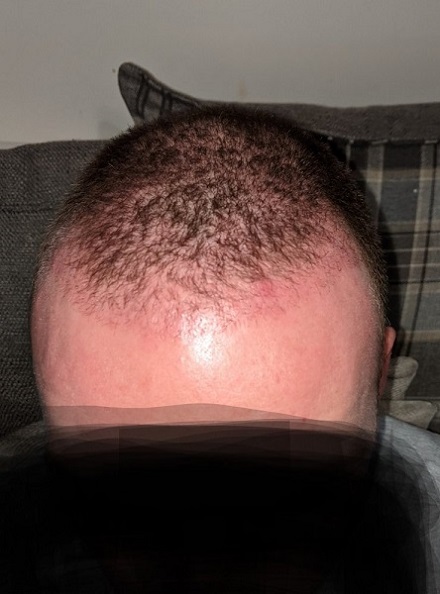 HairDr Leeds Hair Transplant 1.jpg