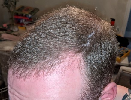 HairDr Leeds Hair Transplant 2.jpg