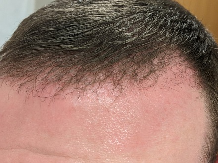HairDr Leeds Hair Transplant 3.jpg