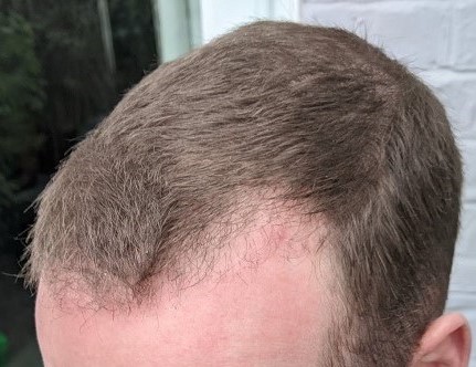 HairDr Leeds Hair Transplant 4.jpg