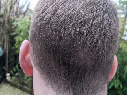 HairDr Leeds Hair Transplant donor area.jpg