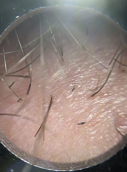 HairDr Leeds Hair Transplant grafts under magnification.jpg