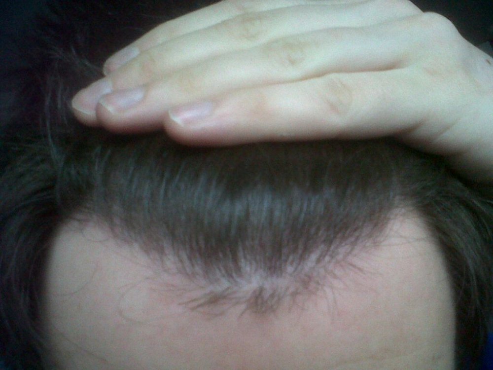 hairline by Dr. Bisanga1.jpg