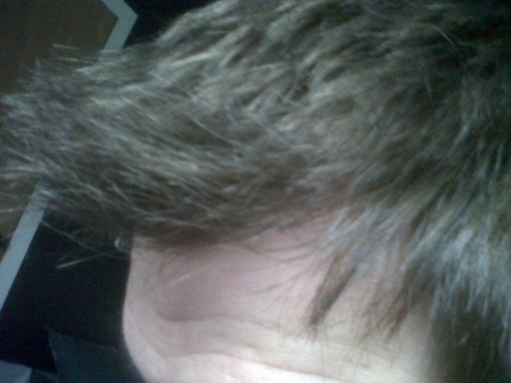 hairline by Dr. Bisanga3.jpg