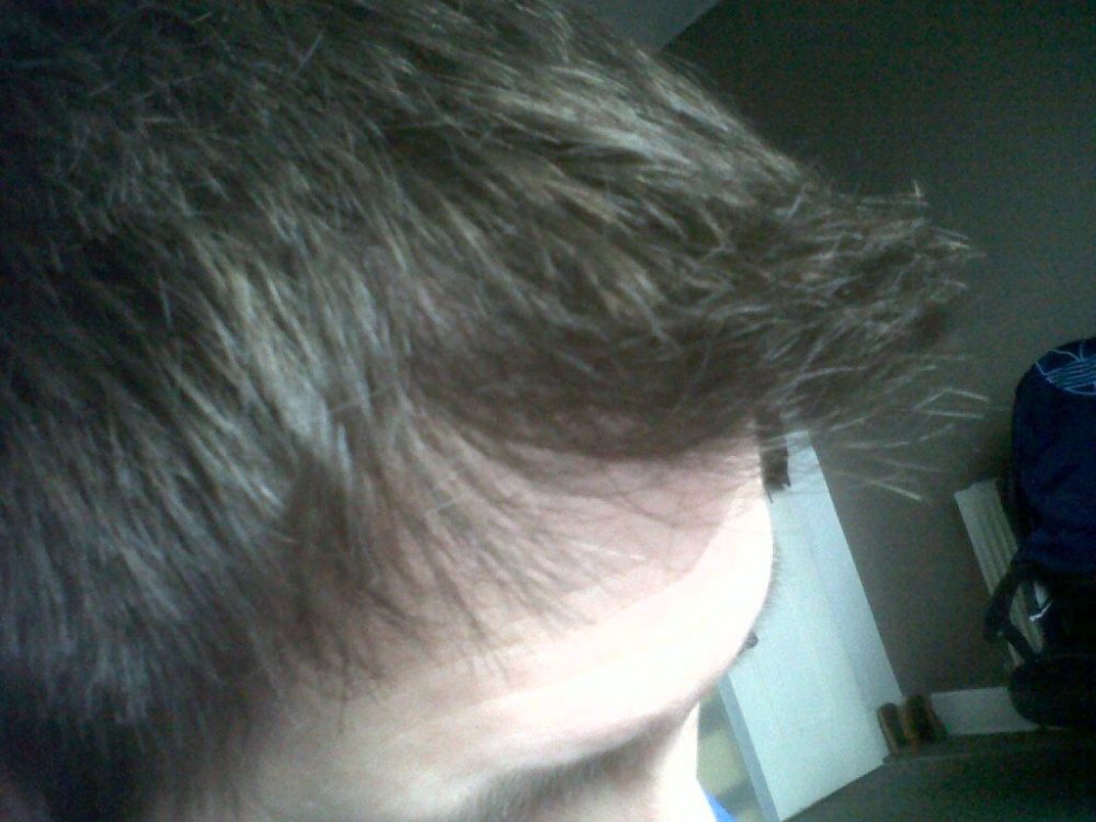 hairline by Dr. Bisanga5.jpg