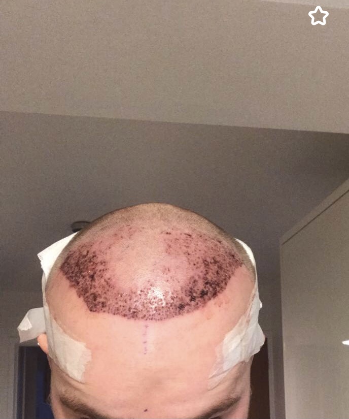 Hairline hair transplant.jpeg