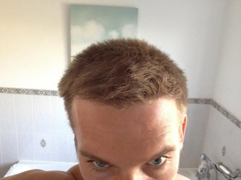 Hairline hair Transplant with HDC Medical.jpg