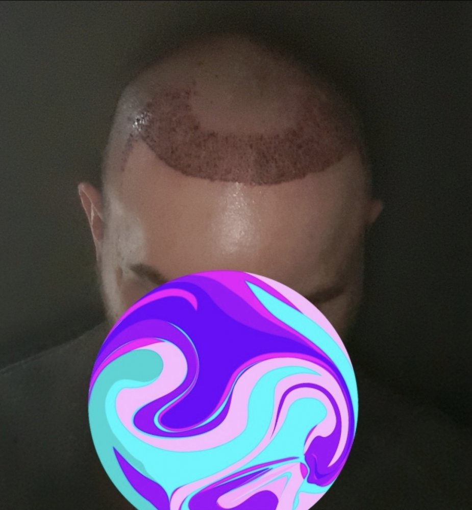 Hairline.jpg