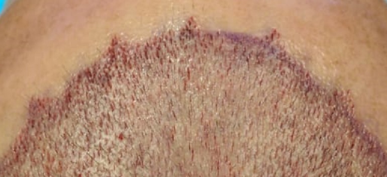 hairline-recipient-sites.jpg