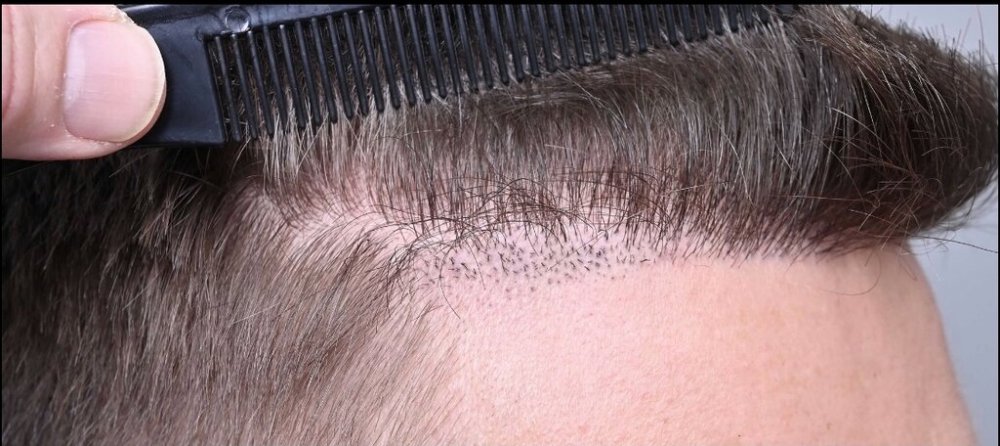 Hairline repair.jpeg