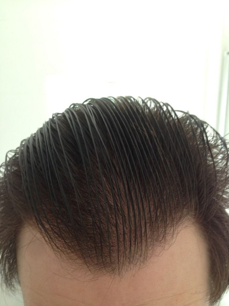 Hairline transplant Dr Bisanga1.jpg