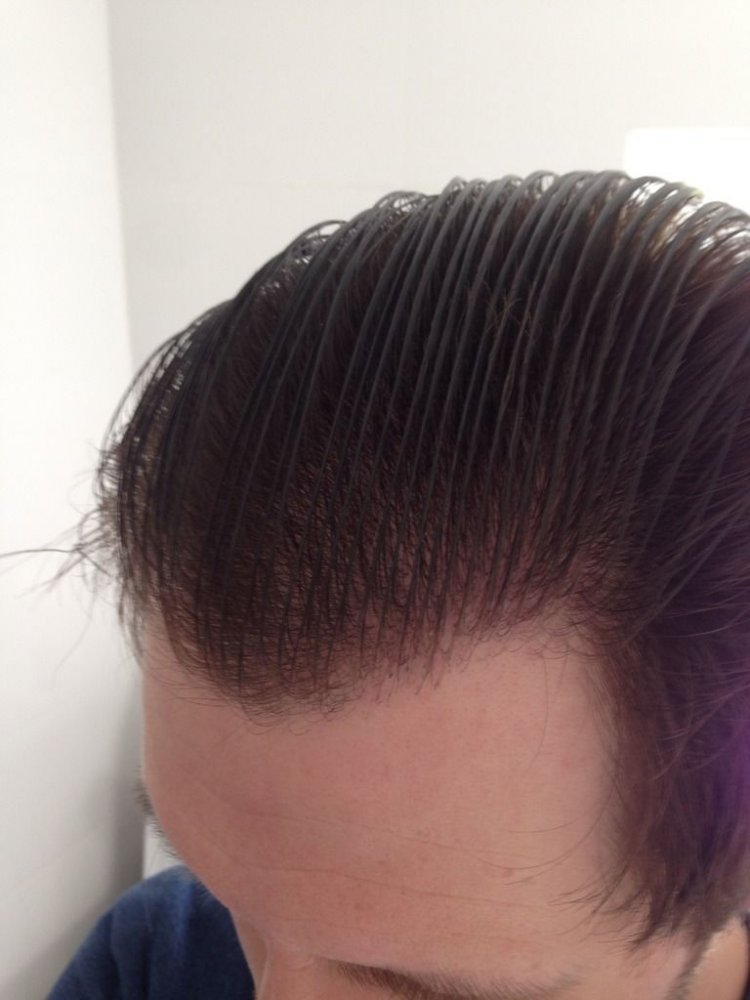Hairline transplant Dr Bisanga2.jpg
