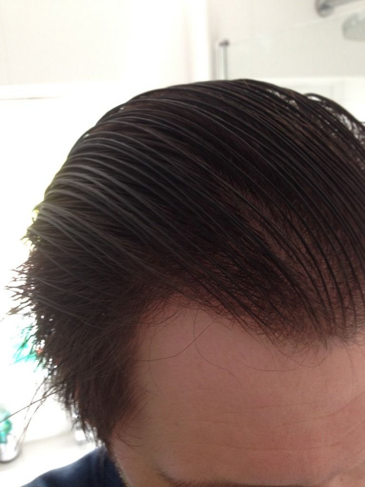 Hairline transplant Dr Bisanga3.jpg