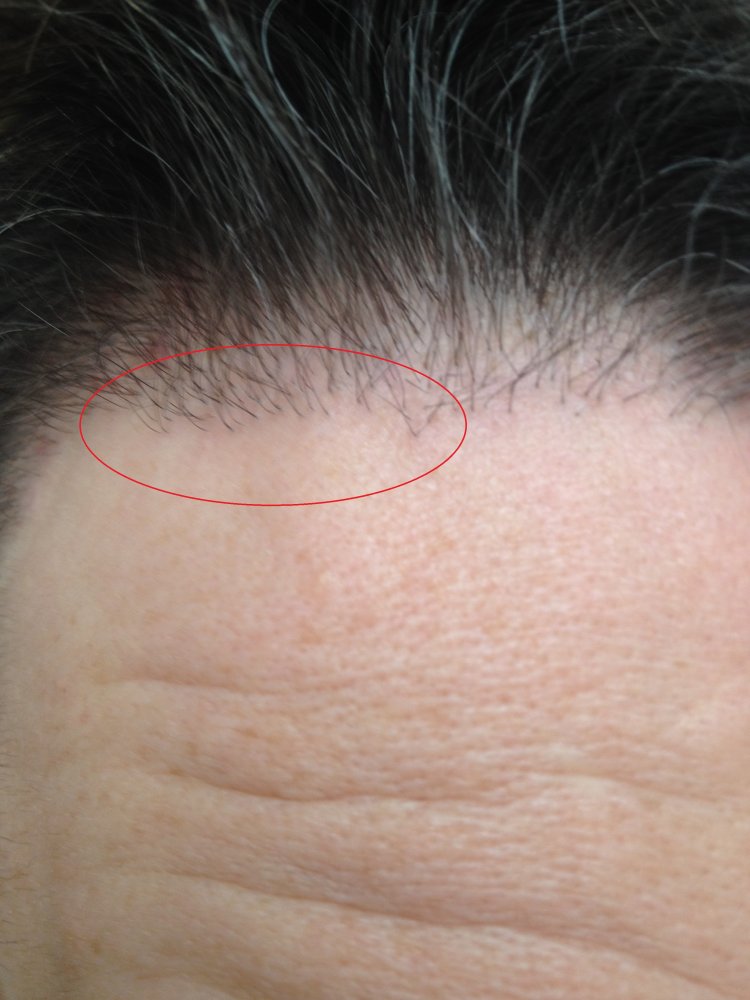 Hairline unnaturally bends down red.jpg