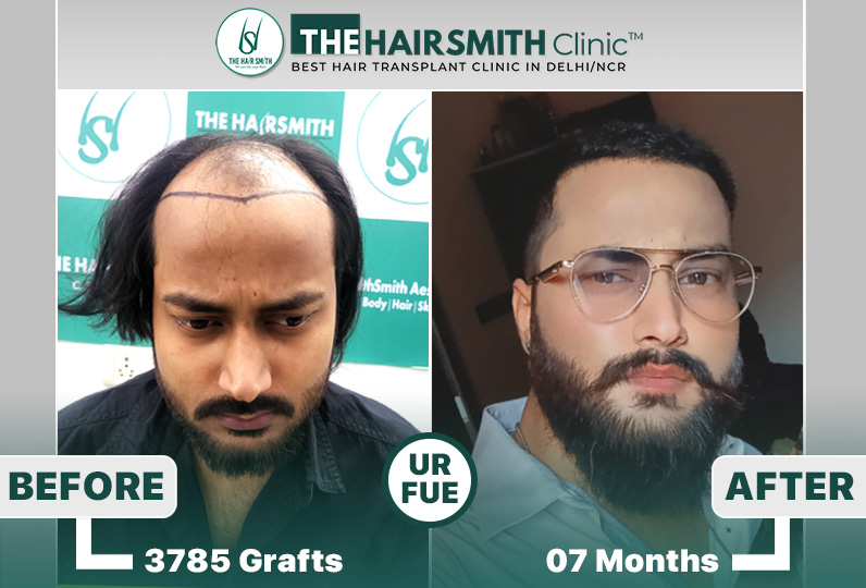 hairsmith clinic hair transplant result - after 11 months result.jpg