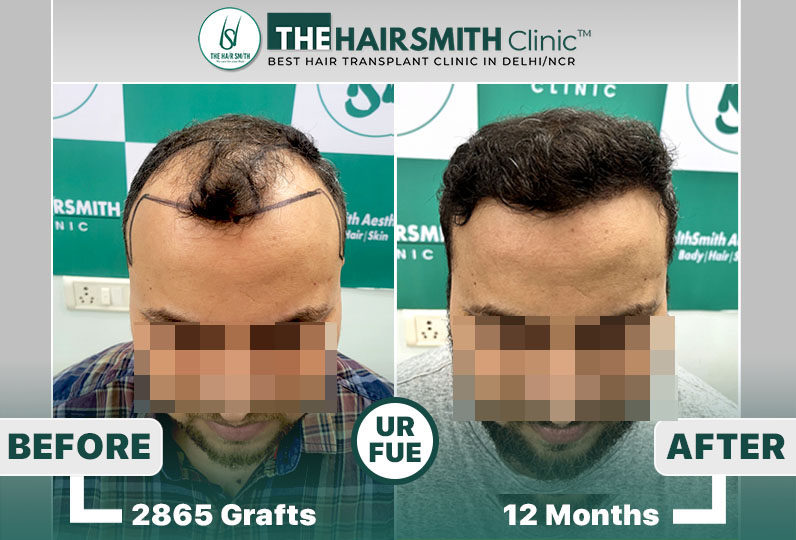hairsmith clinic hair transplant result #urfuehairtransplant #hairsmithhairtransplant.jpg