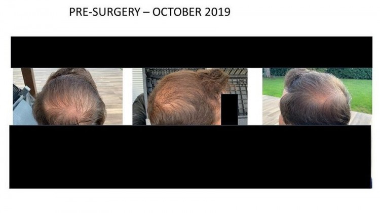 Hattingen Hair Hair Transplant 1.jpg