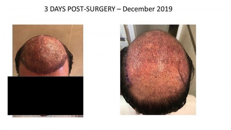 Hattingen Hair Hair Transplant 2.jpg