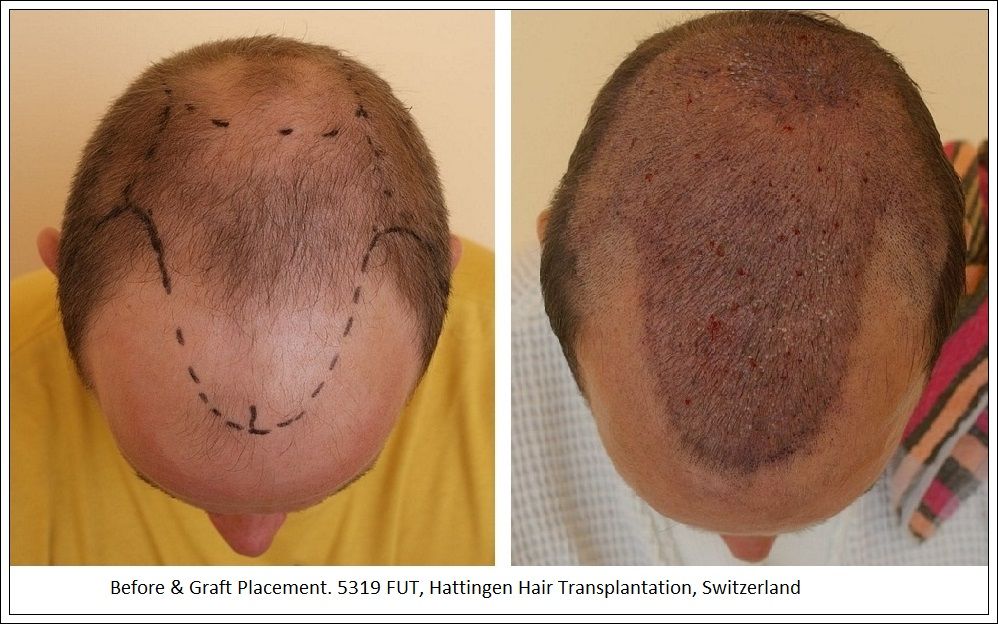 Hattingen Hair Hair Transplant 2.jpg