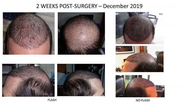 Hattingen Hair Hair Transplant 3.jpg