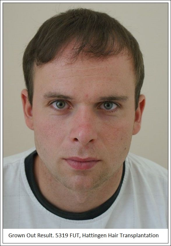 Hattingen Hair Hair Transplant 3.jpg