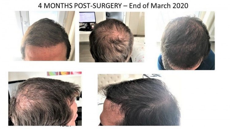 Hattingen Hair Hair Transplant 4.jpg