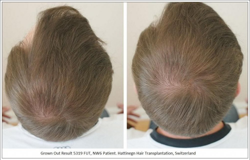 Hattingen Hair Hair Transplant 4.jpg