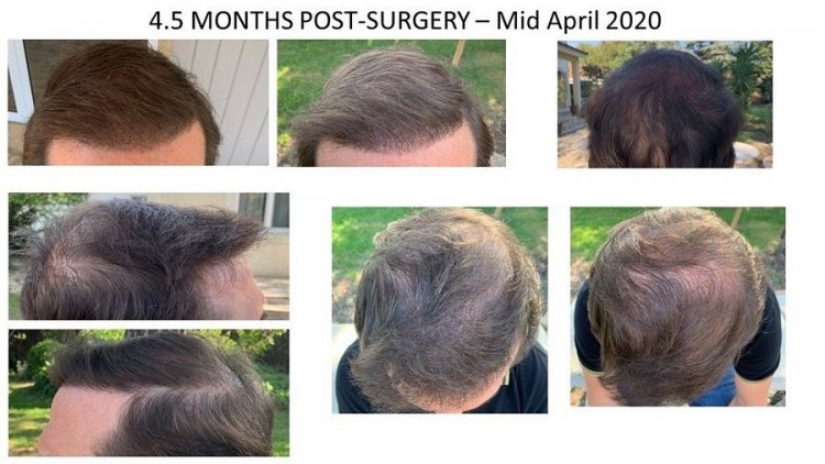 Hattingen Hair Hair Transplant 5.jpg