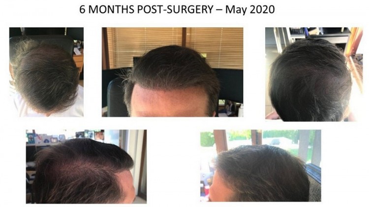 Hattingen Hair Hair Transplant 6.jpg